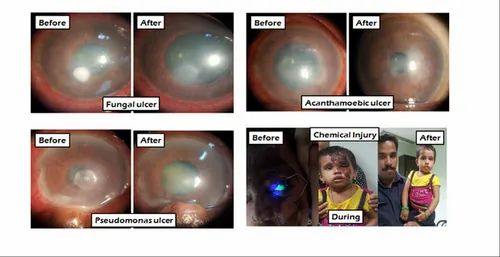 Corneal Ulcers Treatment Services