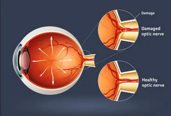 Glaucoma Treatment Services