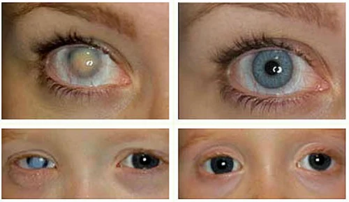 Eyes Contact Lens Services