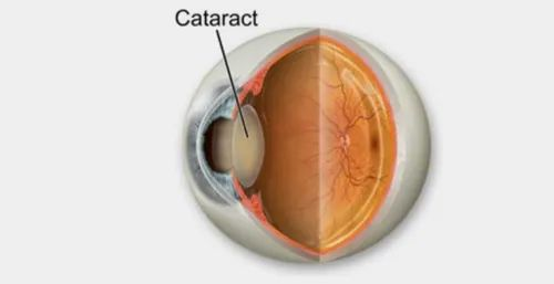 Cataract Clinic Treatment Services