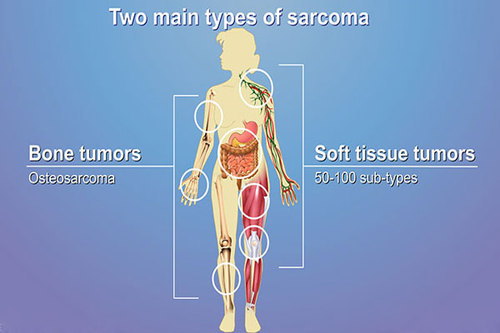 Soft Tissue Tumour Treatment Service