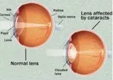 Eye Surgery Service