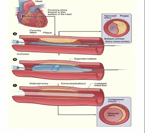 Coronary Angioplasty (Ptca)