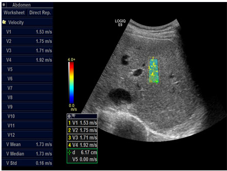 Shear Wave Fibrosis Scan for Liver