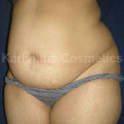 Tummy Tuck