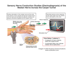 Nerve Conduction Velocity Testing Service