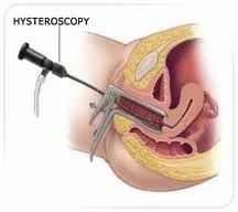 Hysteroscopy