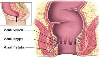 Fistula Treatment Service