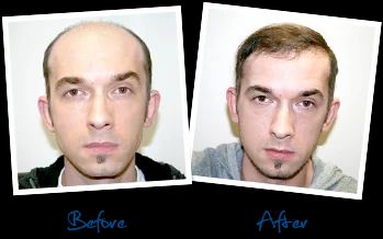 Male Hair Loss Treatments