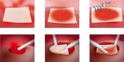 Resorbable Oxidized Cellulose Hemostat