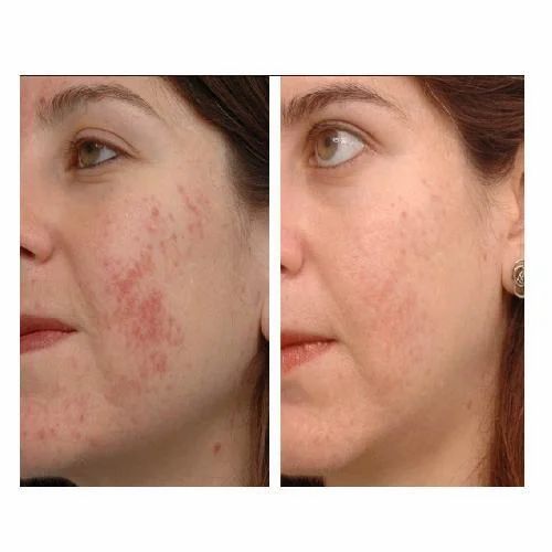 Acne Reduction Treatment