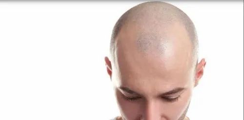 Hair Transplant