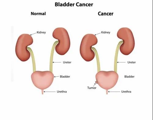 Bladder Cancer Treatments