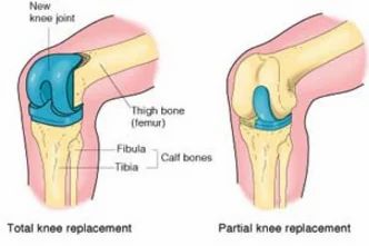 Knee Replacement services