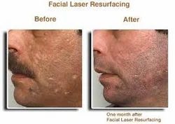 Laser Facial Rejunevation