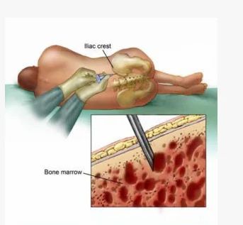 Bone Marrow Treatment Service