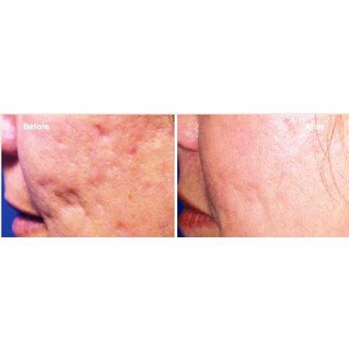 Scar Reduction Treatment