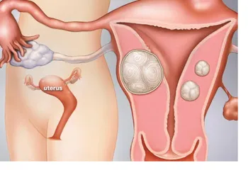 Advanced Laparoscopic Gynae Surgery Services