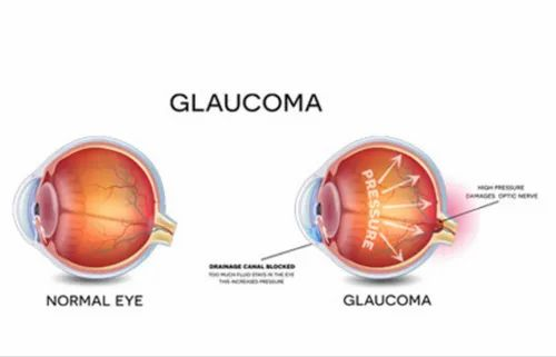 Glaucoma Treatment Services