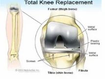 Total Knee Replacement Surgery Service